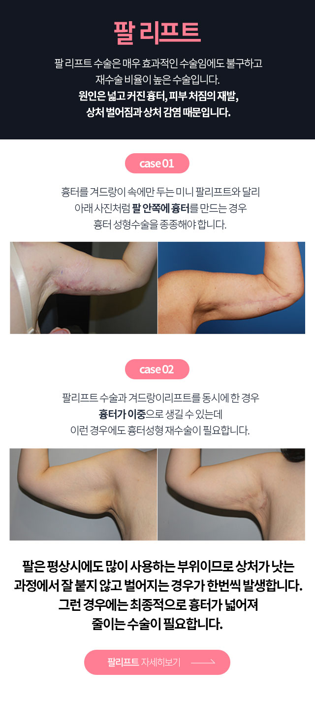 팔리프팅 자세히보기