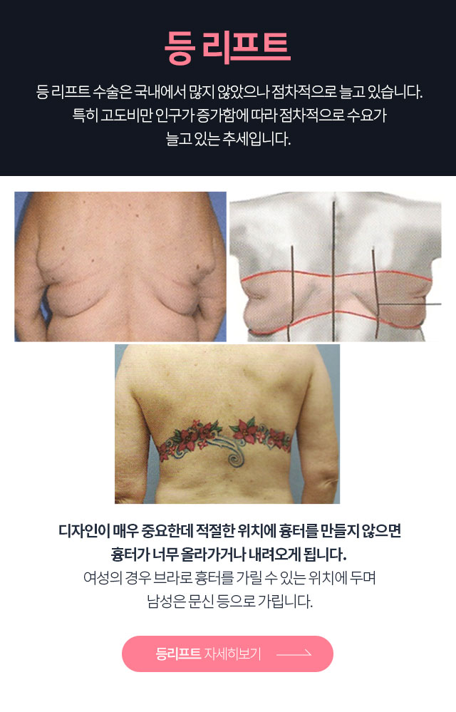 등리프팅 자세히보기