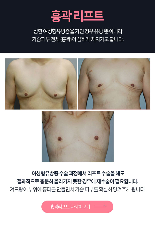 흉곽리프팅 자세히보기