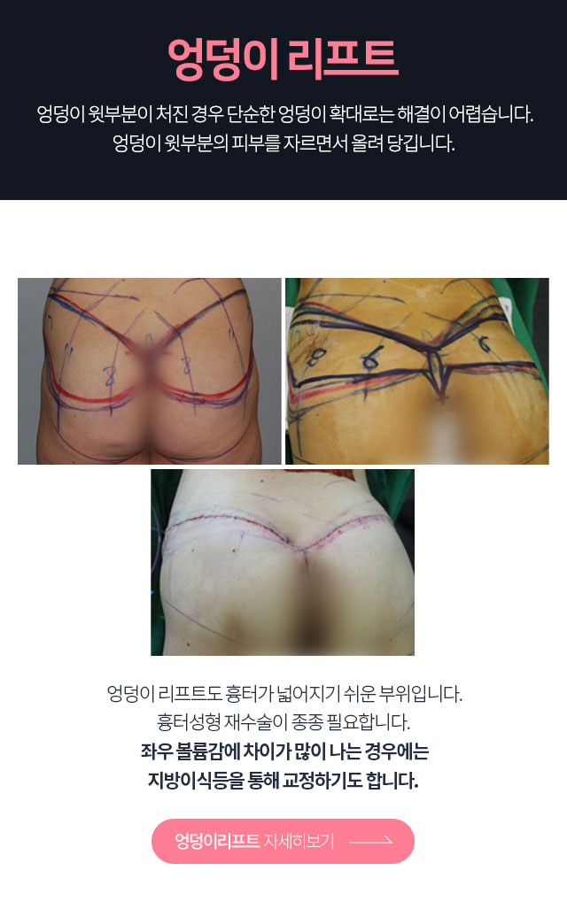 엉덩이리프팅 자세히보기