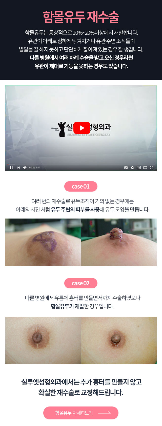 함몰유두 자세히보기