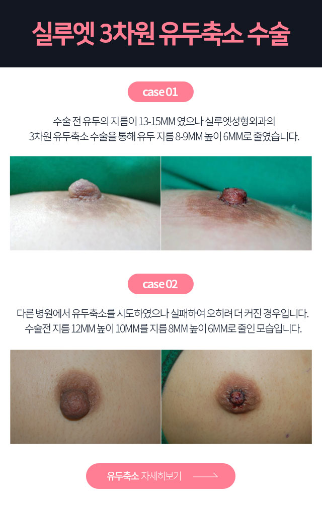 유륜축소재수술 자세히보기