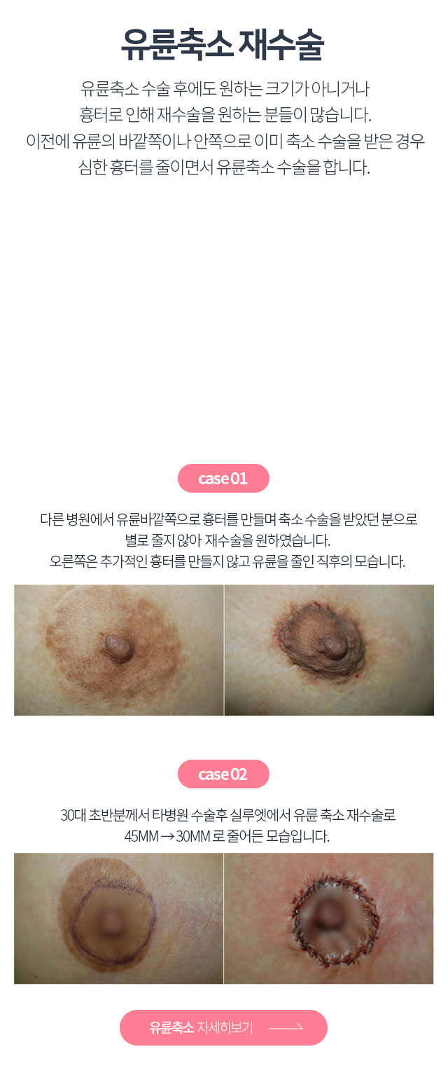 유륜축소재수술 자세히보기