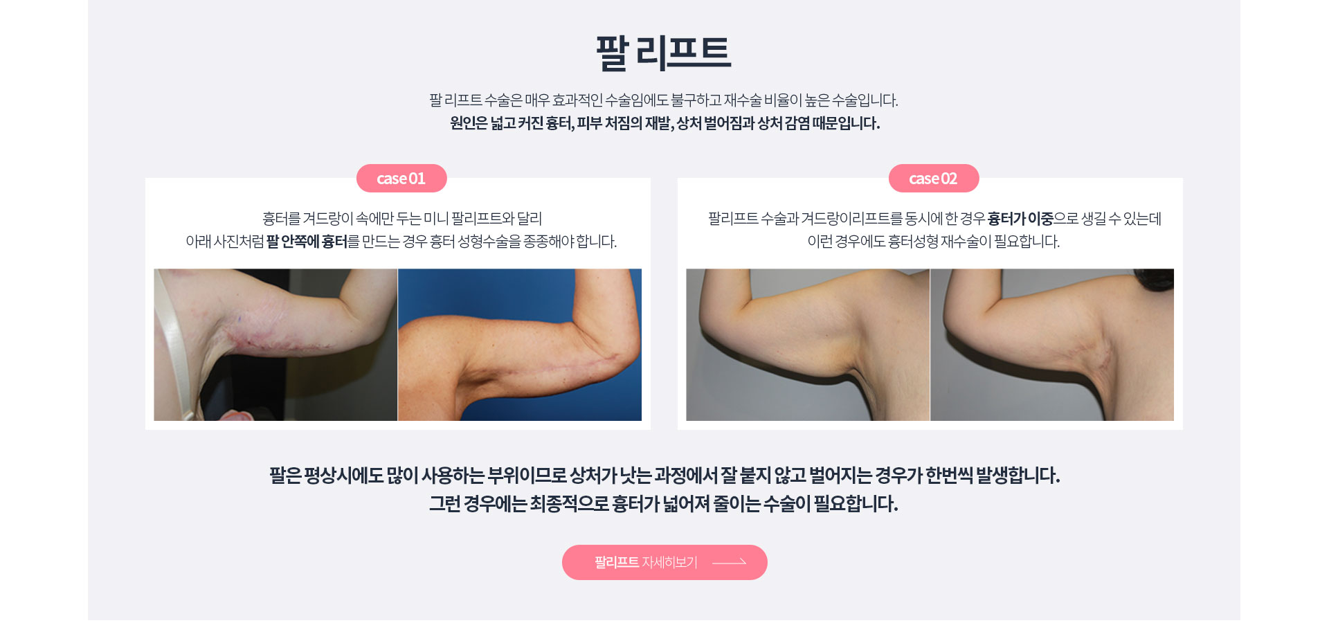 팔리프팅 자세히보기