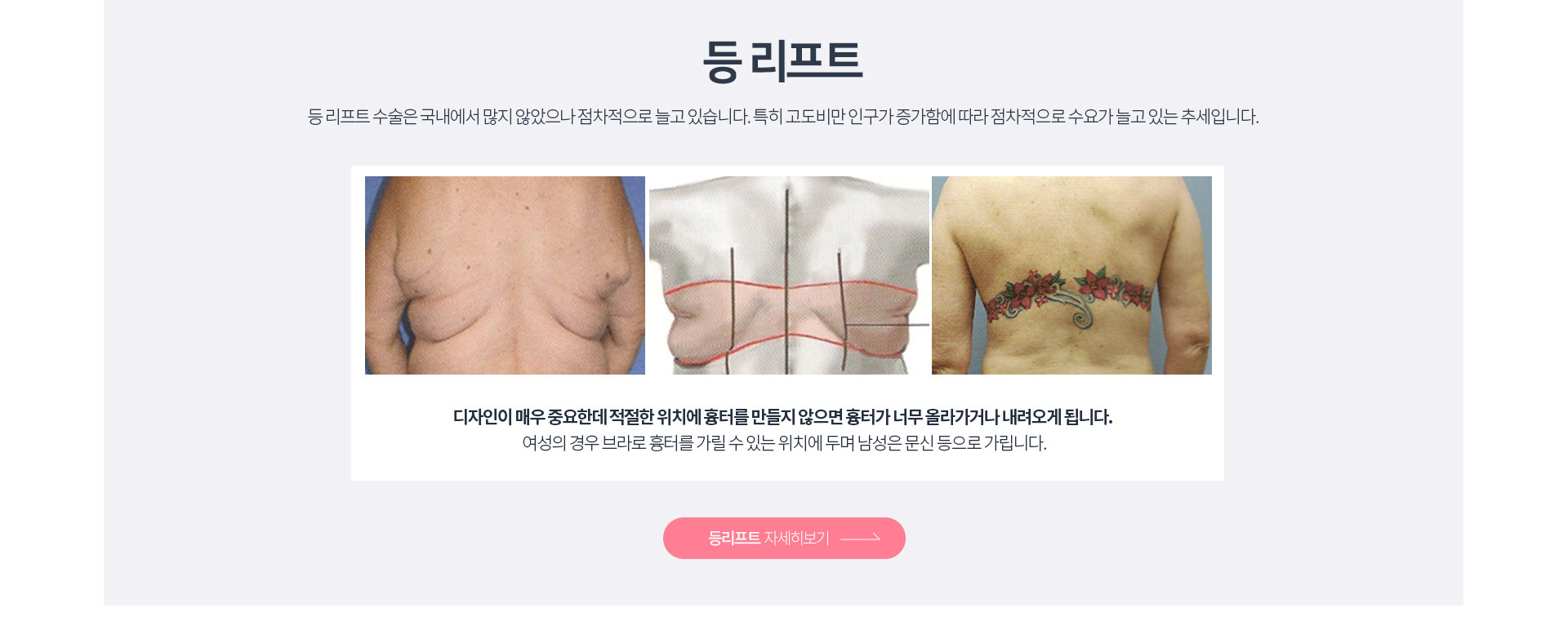등리프팅 자세히보기