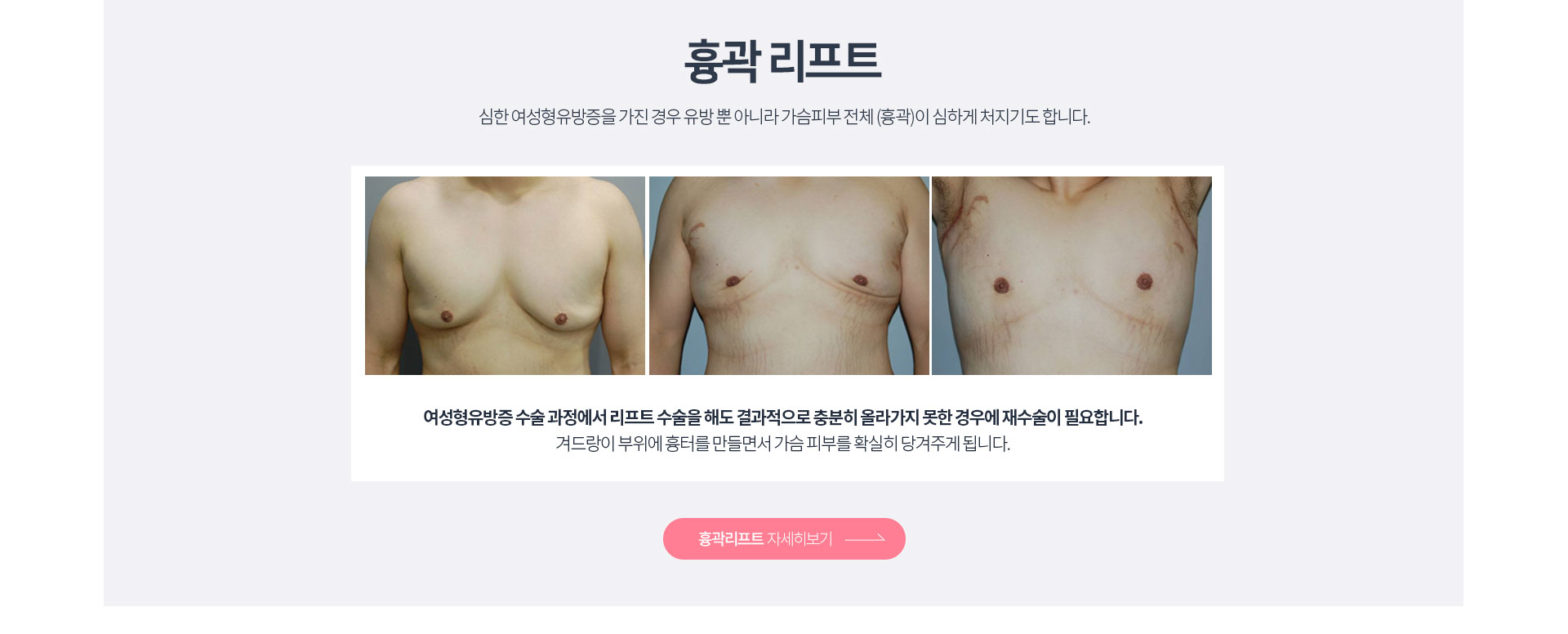 흉곽리프팅 자세히보기