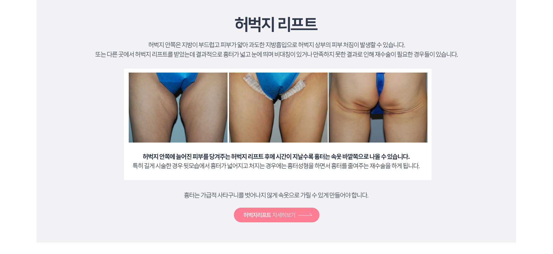 허벅지리프팅 자세히보기