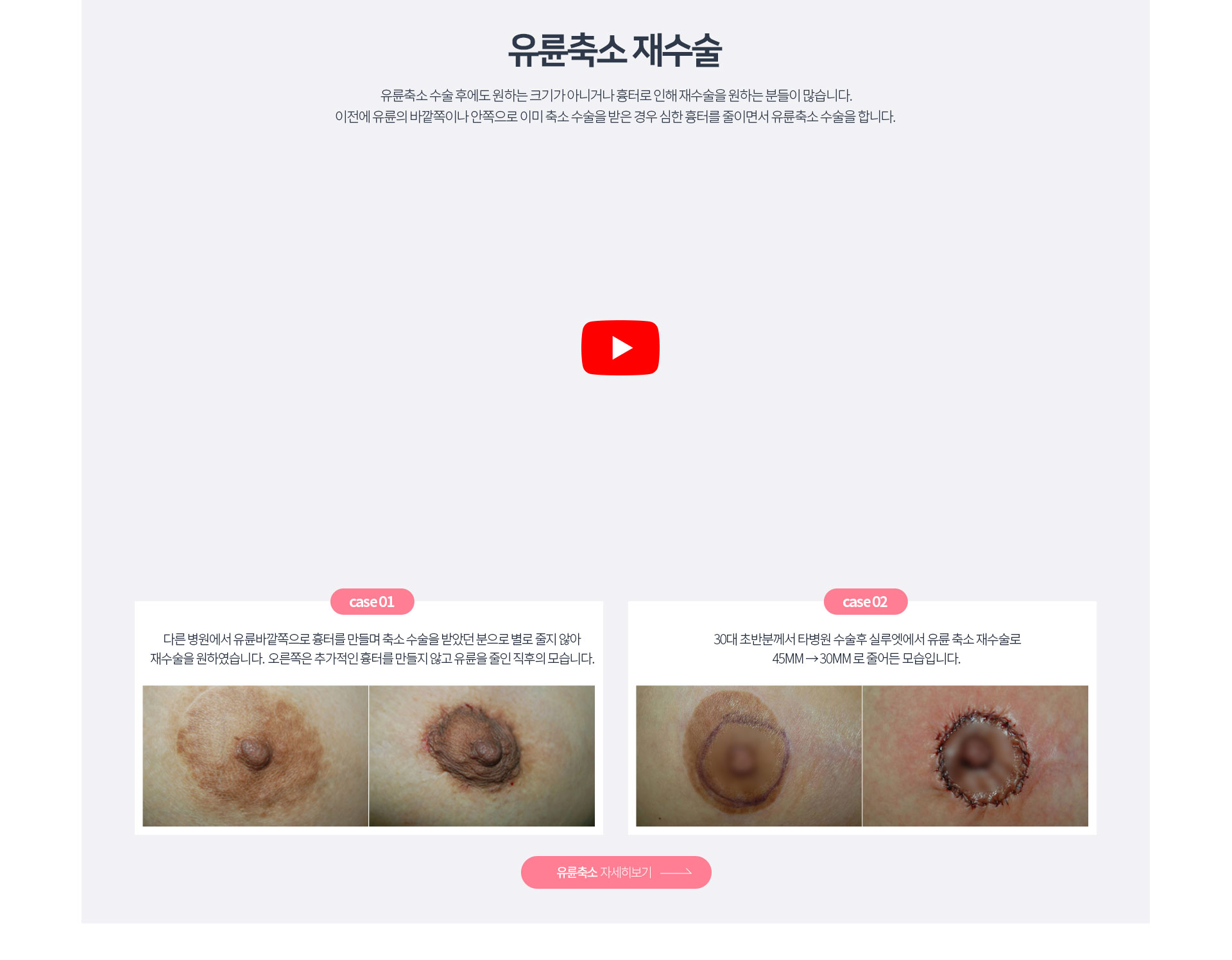 유륜축소재수술 자세히보기